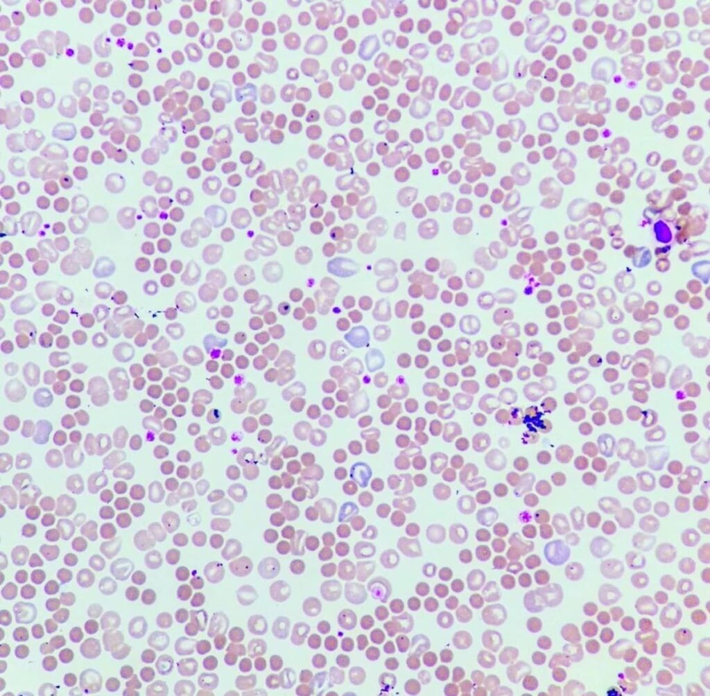 Hematología