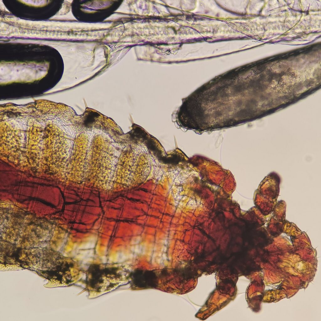 Parasitología y mala asimilación de nutrientes